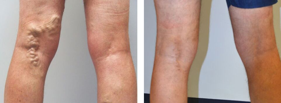 Fotografie înainte și după utilizarea Veniselle, experiența de a folosi cremă