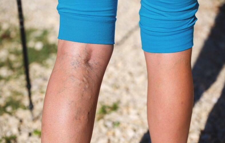 Deteriorarea extremităților inferioare