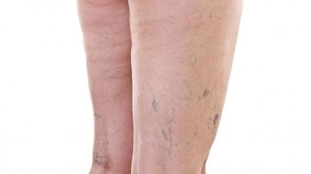 Simptomele vaselor de sânge