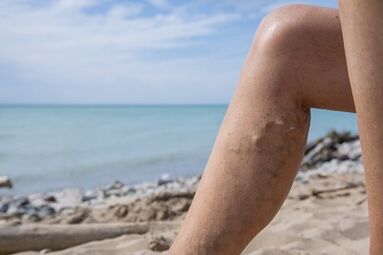 Vene varicoase pe picioare