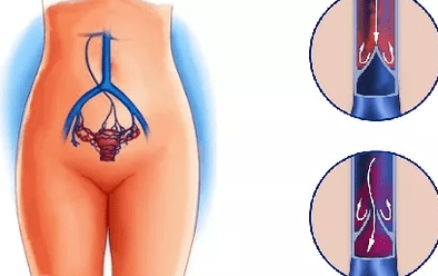 Motivele dezvoltării varicelor pelvisului