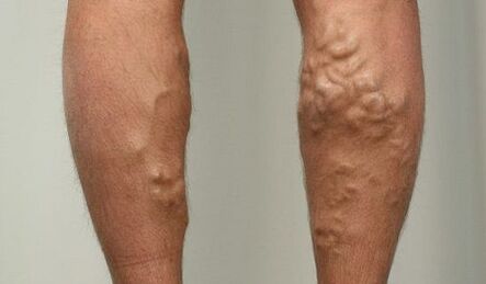 Simptome ale varicelor