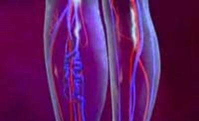 Cauzele și tratamentul venelor varicoase