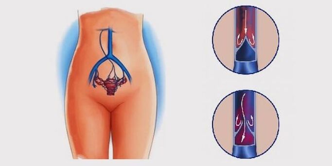 Vene varicoase ale pelvisului