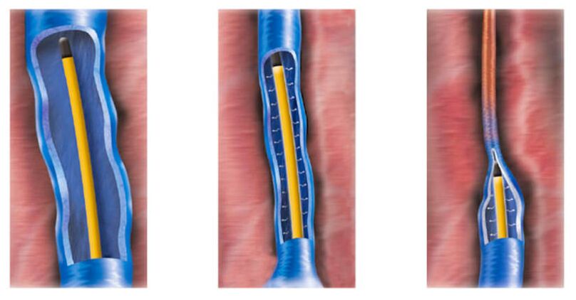 ablația cu radiofrecvență ca metodă de tratare a venelor varicoase