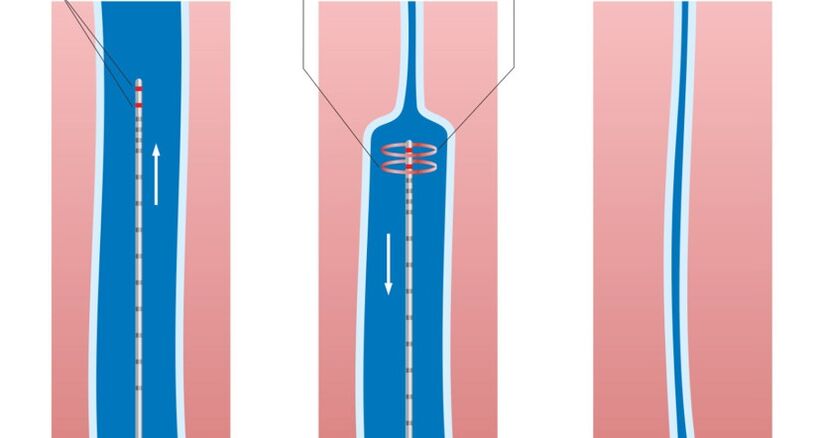 tratament cu laser pentru vene varicoase de pe picioare