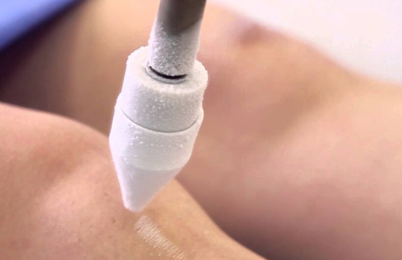 tratamentul varicelor de la picioare cu crioterapie