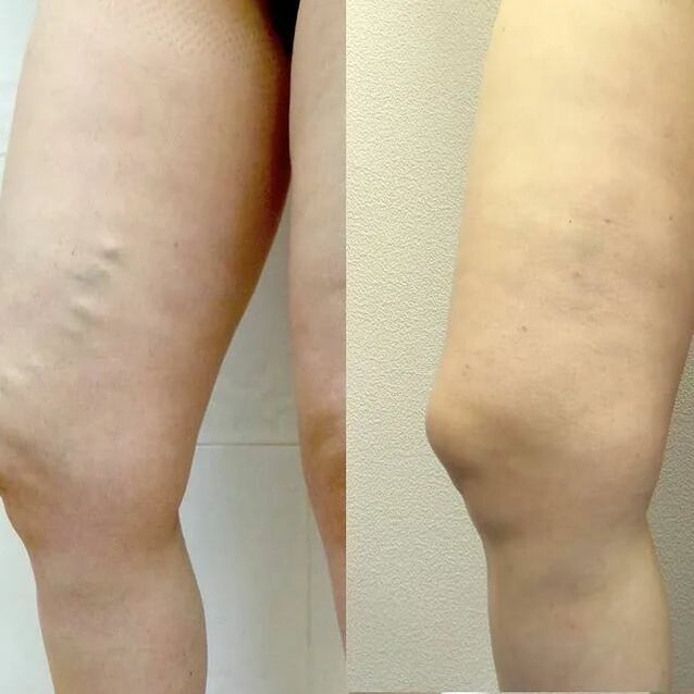înainte și după tratamentul venelor varicoase